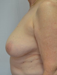 Breast Lift Before Photo by Mark McRae, MD, FRCS(C); Burlington, ON - Case 47499