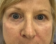 Eyelid Surgery After Photo by Mark McRae, MD, FRCS(C); Burlington, ON - Case 47867