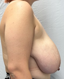 Breast Reduction Before Photo by Mark McRae, MD, FRCS(C); Burlington, ON - Case 47974