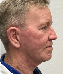 Facelift After Photo by Mark McRae, MD, FRCS(C); Burlington, ON - Case 47975