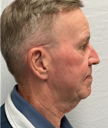 Facelift Before Photo by Mark McRae, MD, FRCS(C); Burlington, ON - Case 47975