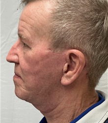 Facelift After Photo by Mark McRae, MD, FRCS(C); Burlington, ON - Case 47975