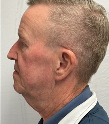 Facelift Before Photo by Mark McRae, MD, FRCS(C); Burlington, ON - Case 47975