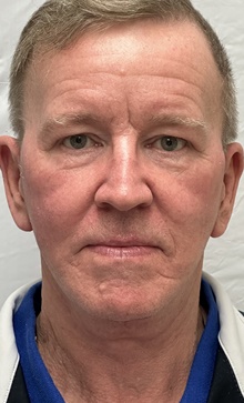 Facelift After Photo by Mark McRae, MD, FRCS(C); Burlington, ON - Case 47975