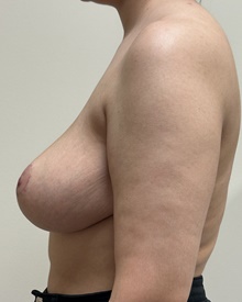 Breast Reduction After Photo by Mark McRae, MD, FRCS(C); Burlington, ON - Case 48289