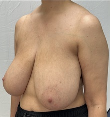 Breast Reduction Before Photo by Mark McRae, MD, FRCS(C); Burlington, ON - Case 48289