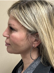 Facelift After Photo by Mark McRae, MD, FRCS(C); Burlington, ON - Case 48357