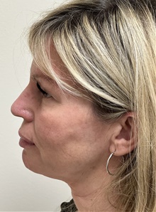 Facelift Before Photo by Mark McRae, MD, FRCS(C); Burlington, ON - Case 48357