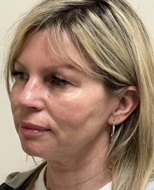 Facelift Before Photo by Mark McRae, MD, FRCS(C); Burlington, ON - Case 48357