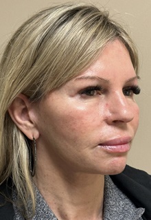 Facelift After Photo by Mark McRae, MD, FRCS(C); Burlington, ON - Case 48357