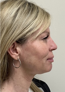 Facelift Before Photo by Mark McRae, MD, FRCS(C); Burlington, ON - Case 48357