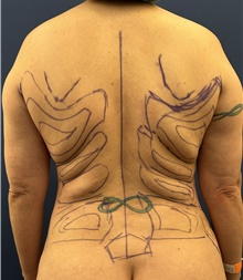 Liposuction Before Photo by Mark McRae, MD, FRCS(C); Burlington, ON - Case 48393
