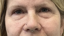 Eyelid Surgery After Photo by Mark McRae, MD, FRCS(C); Burlington, ON - Case 48436