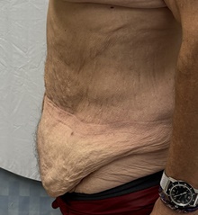 Tummy Tuck Before Photo by Mark McRae, MD, FRCS(C); Burlington, ON - Case 48596