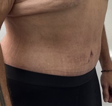 Tummy Tuck After Photo by Mark McRae, MD, FRCS(C); Burlington, ON - Case 48596