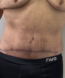 Tummy Tuck After Photo by Mark McRae, MD, FRCS(C); Burlington, ON - Case 48596