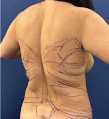Liposuction Before Photo by Mark McRae, MD, FRCS(C); Burlington, ON - Case 48652