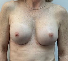 Breast Implant Revision After Photo by Mark McRae, MD, FRCS(C); Burlington, ON - Case 49118