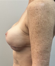 Breast Implant Revision Before Photo by Mark McRae, MD, FRCS(C); Burlington, ON - Case 49118