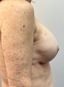 Breast Implant Revision After Photo by Mark McRae, MD, FRCS(C); Burlington, ON - Case 49118