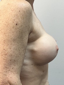 Breast Implant Revision Before Photo by Mark McRae, MD, FRCS(C); Burlington, ON - Case 49118