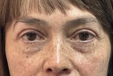 Eyelid Surgery After Photo by Mark McRae, MD, FRCS(C); Burlington, ON - Case 49269