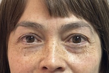 Eyelid Surgery Before Photo by Mark McRae, MD, FRCS(C); Burlington, ON - Case 49269