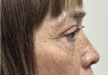 Eyelid Surgery After Photo by Mark McRae, MD, FRCS(C); Burlington, ON - Case 49269