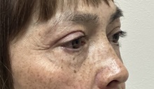 Eyelid Surgery After Photo by Mark McRae, MD, FRCS(C); Burlington, ON - Case 49269