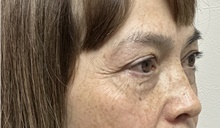 Eyelid Surgery Before Photo by Mark McRae, MD, FRCS(C); Burlington, ON - Case 49269