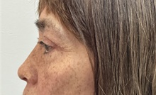 Eyelid Surgery After Photo by Mark McRae, MD, FRCS(C); Burlington, ON - Case 49269