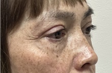 Eyelid Surgery After Photo by Mark McRae, MD, FRCS(C); Burlington, ON - Case 49269