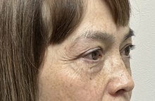 Eyelid Surgery Before Photo by Mark McRae, MD, FRCS(C); Burlington, ON - Case 49269