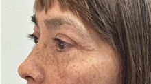 Eyelid Surgery After Photo by Mark McRae, MD, FRCS(C); Burlington, ON - Case 49269