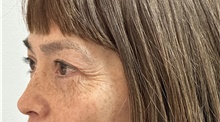 Eyelid Surgery Before Photo by Mark McRae, MD, FRCS(C); Burlington, ON - Case 49269