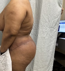 Body Contouring After Photo by Mark McRae, MD, FRCS(C); Burlington, ON - Case 49271