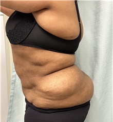 Body Contouring Before Photo by Mark McRae, MD, FRCS(C); Burlington, ON - Case 49271