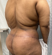 Body Contouring After Photo by Mark McRae, MD, FRCS(C); Burlington, ON - Case 49271