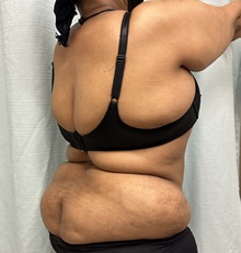 Body Contouring Before Photo by Mark McRae, MD, FRCS(C); Burlington, ON - Case 49271