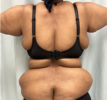 Body Contouring Before Photo by Mark McRae, MD, FRCS(C); Burlington, ON - Case 49271