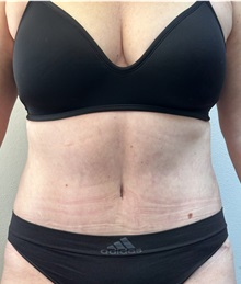 Tummy Tuck After Photo by Mark McRae, MD, FRCS(C); Burlington, ON - Case 49365