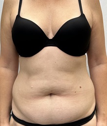 Tummy Tuck Before Photo by Mark McRae, MD, FRCS(C); Burlington, ON - Case 49365