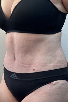 Tummy Tuck After Photo by Mark McRae, MD, FRCS(C); Burlington, ON - Case 49365