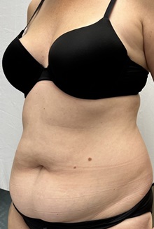 Tummy Tuck Before Photo by Mark McRae, MD, FRCS(C); Burlington, ON - Case 49365