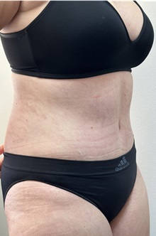 Tummy Tuck After Photo by Mark McRae, MD, FRCS(C); Burlington, ON - Case 49365