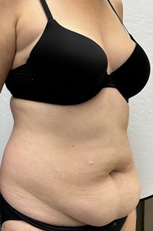 Tummy Tuck Before Photo by Mark McRae, MD, FRCS(C); Burlington, ON - Case 49365