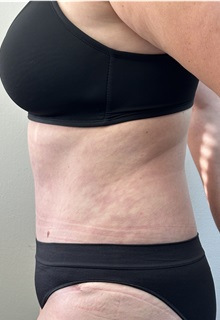 Tummy Tuck After Photo by Mark McRae, MD, FRCS(C); Burlington, ON - Case 49365