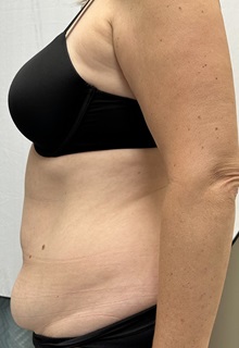 Tummy Tuck Before Photo by Mark McRae, MD, FRCS(C); Burlington, ON - Case 49365