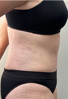 Tummy Tuck After Photo by Mark McRae, MD, FRCS(C); Burlington, ON - Case 49365