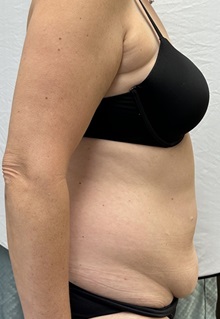 Tummy Tuck Before Photo by Mark McRae, MD, FRCS(C); Burlington, ON - Case 49365